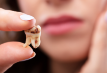 Cách Phòng Ngừa Sâu Răng Hiệu Quả – Bí Quyết Giữ Gìn Nụ Cười Khỏe Mạnh